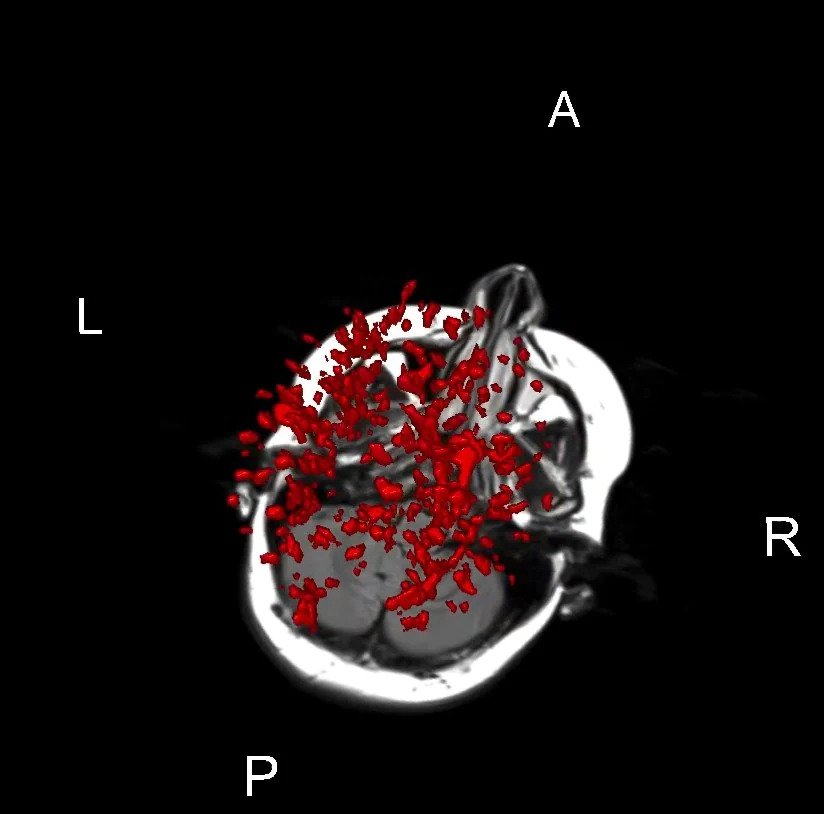 3D segmentation of multiple sclerosis ‘lesions’ (red) from a patient with relapsing and remitting disease. Credit for images: Dr Tim Wang/SNAC