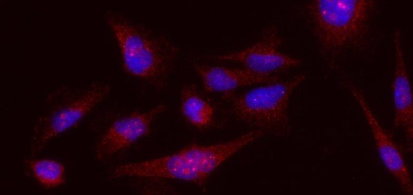 Melanoma cells stained with the BAK1 (red) and Dapi (blue).