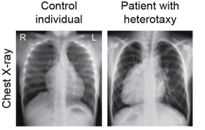 Chest X-ray of a control individual (left), with his heart pointing to the left (L), while the chest  X-ray of a patient with heterotaxy (right) revealed that his heart is inversely positioned  pointing instead to the right (R). 